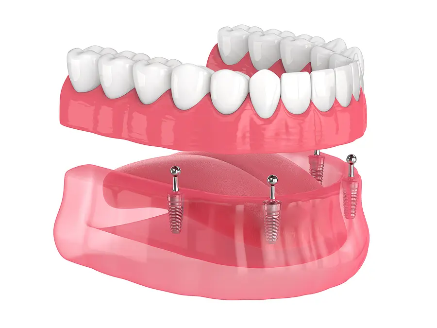 Achieve a Confident Smile with Implant Overdentures in Vero Beach, FL