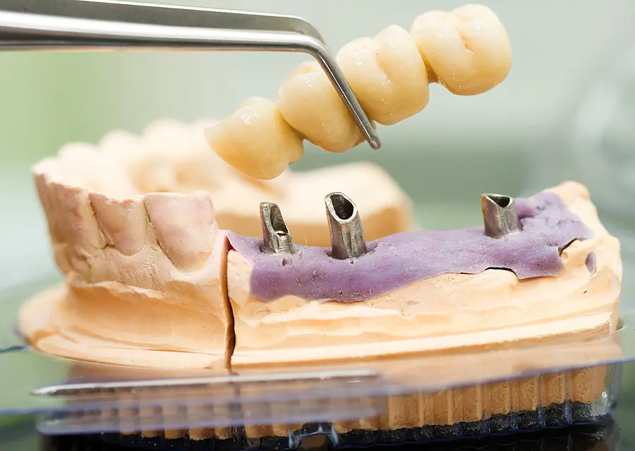 Restoring Your Smile with Implant Crowns and Bridges in Vero Beach, FL